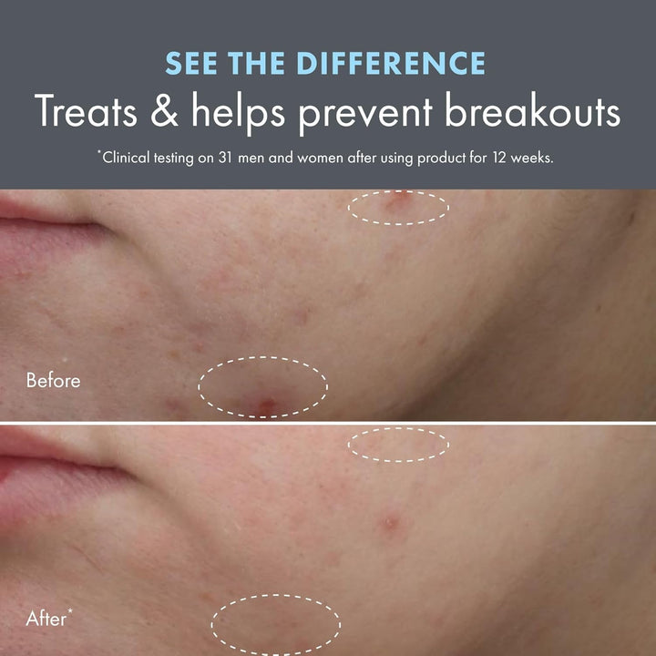 Origins Crema hidratante para acné Clear Improvement | Para elimina...