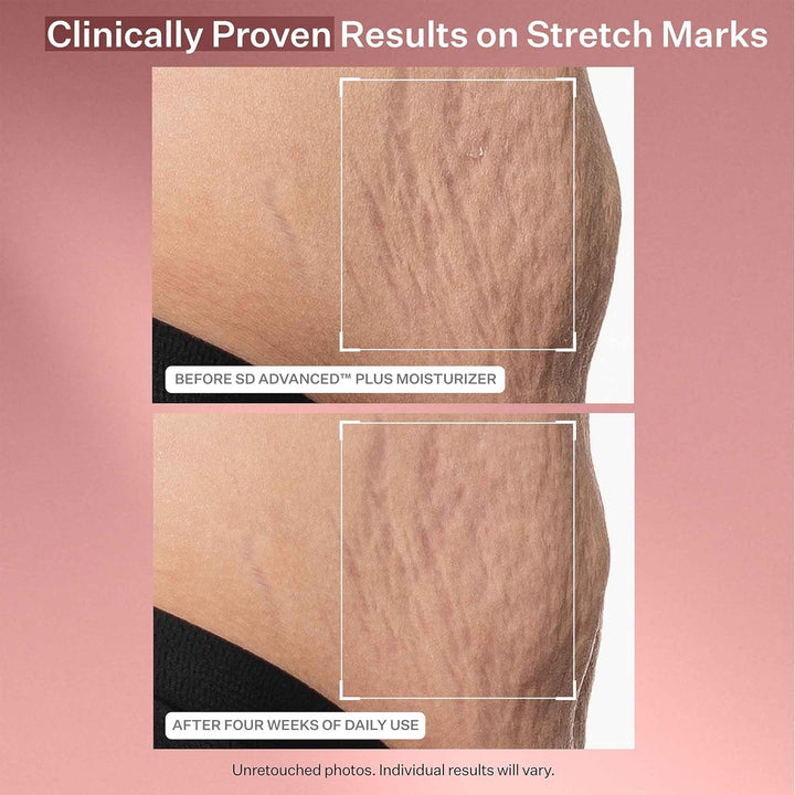 StriVectin SD Advanced Plus Hidratante Intensivo para Arrugas y Est...