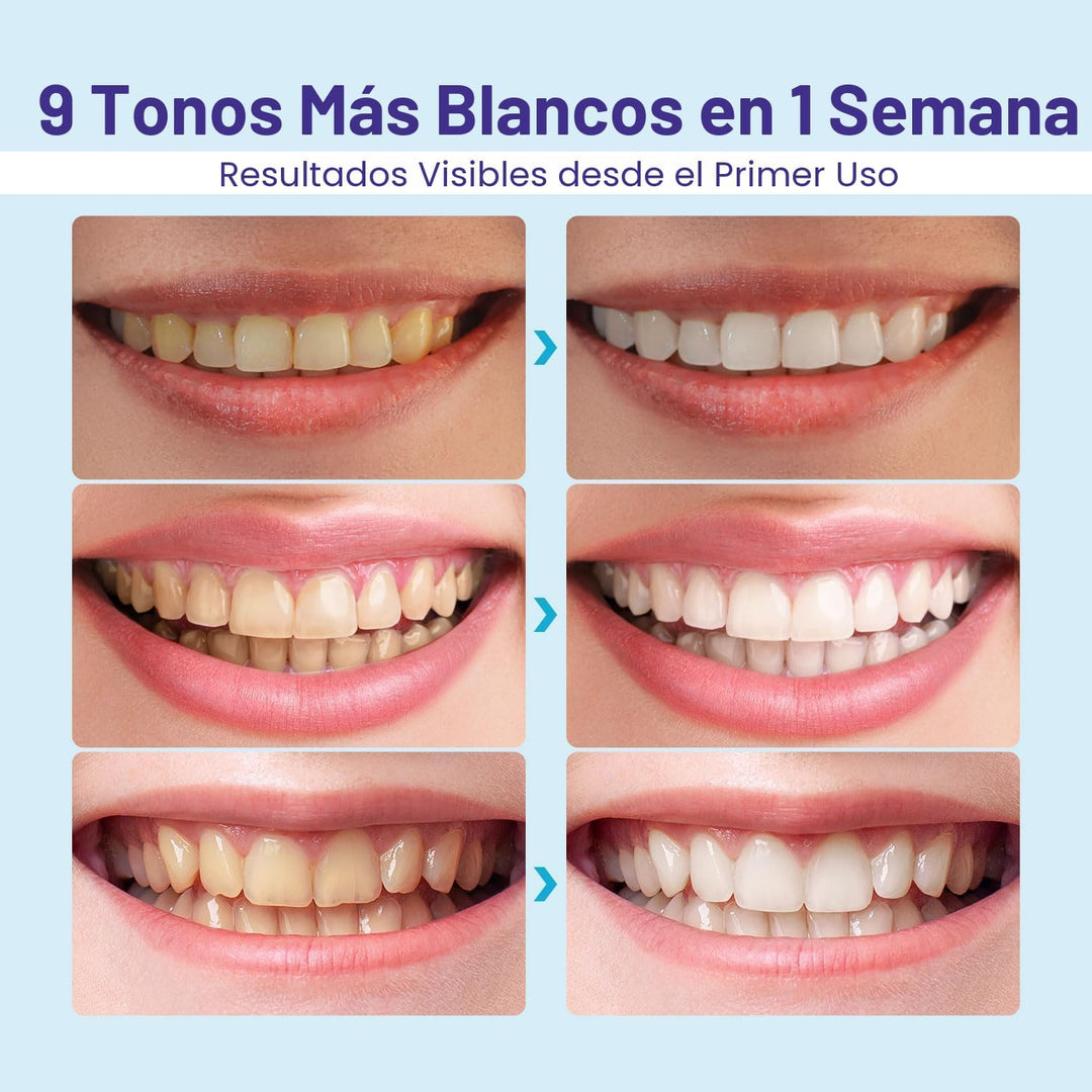 Kit blanqueador de dientes Whitebite Pro para dientes sensibles \u2...
