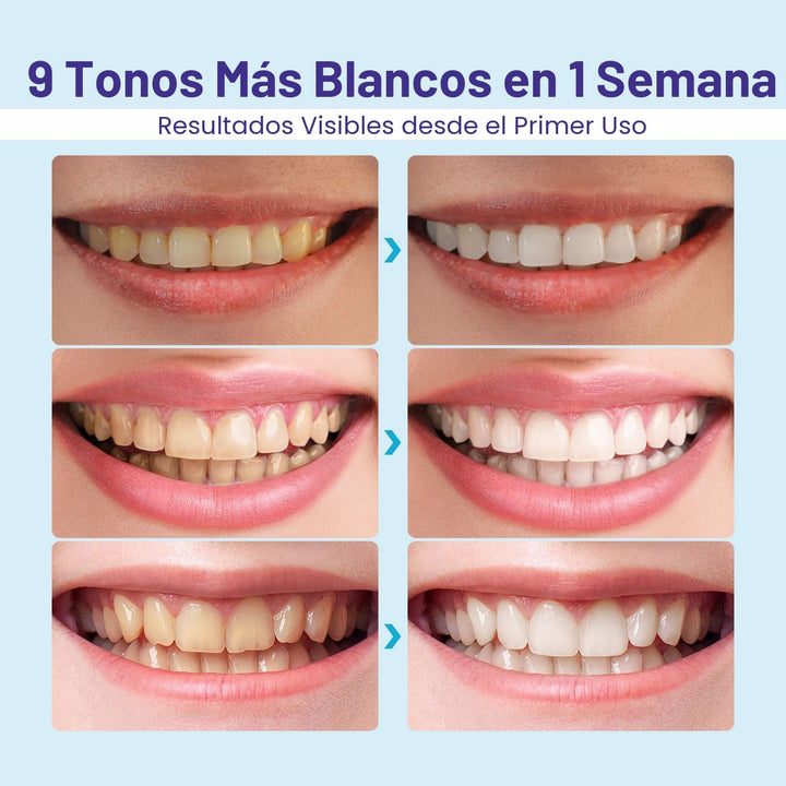 Kit blanqueador de dientes Whitebite Pro para dientes sensibles \u2...