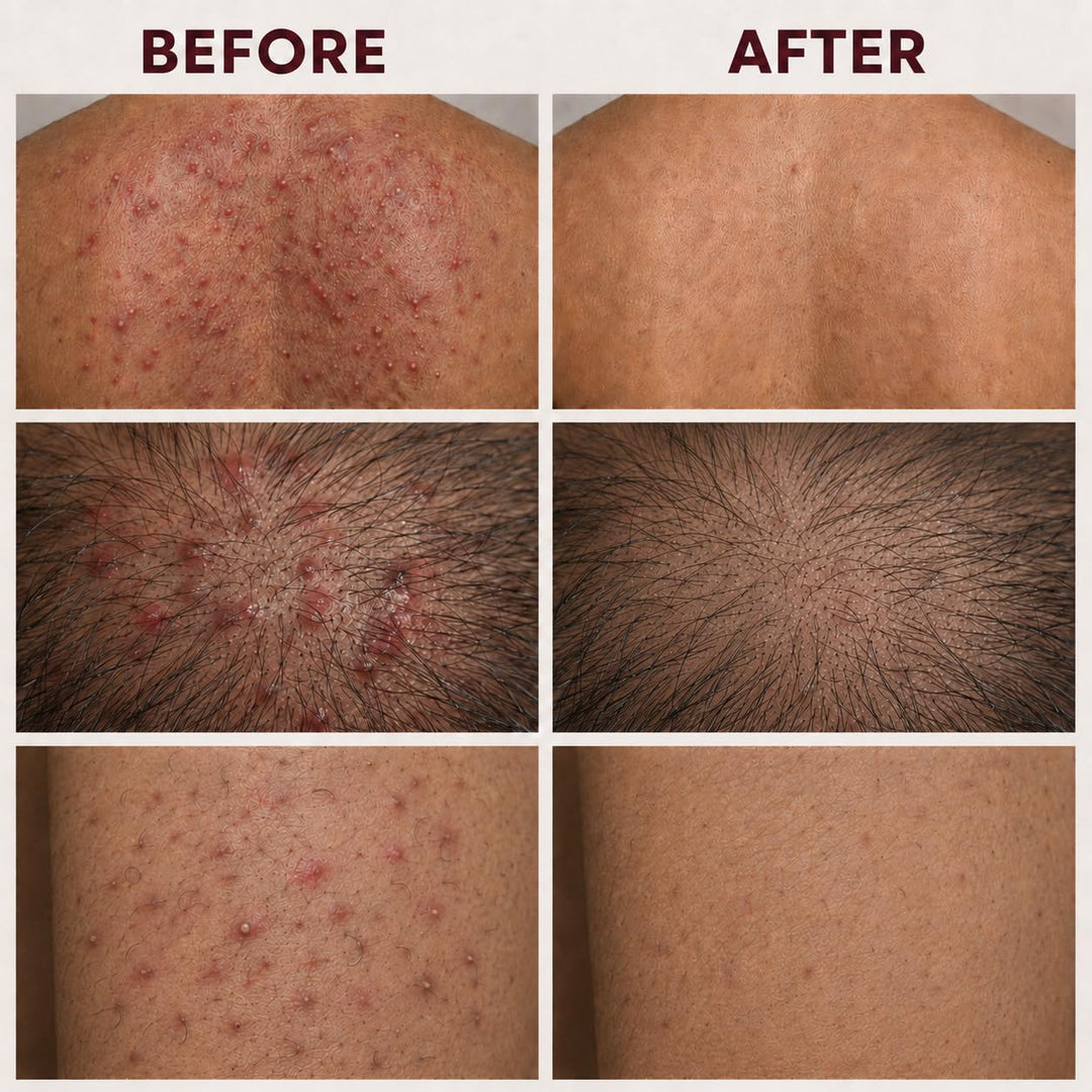 Crema de tratamiento de foliculitis con 5% de peróxido de benzoilo...