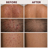 Crema de tratamiento de foliculitis con 5% de peróxido de benzoilo...
