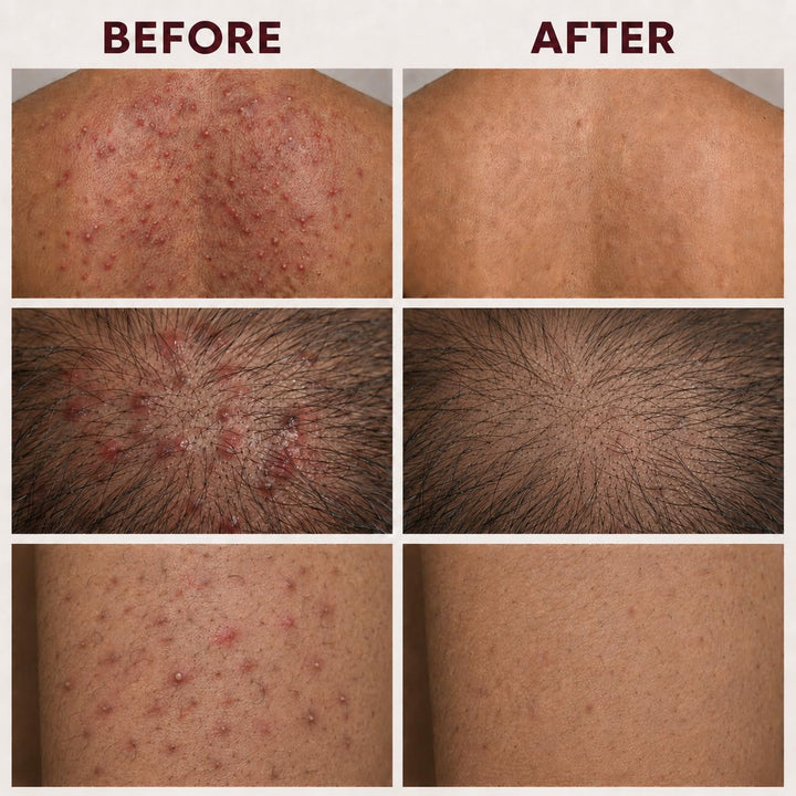 Crema de tratamiento de foliculitis con 5% de peróxido de benzoilo...