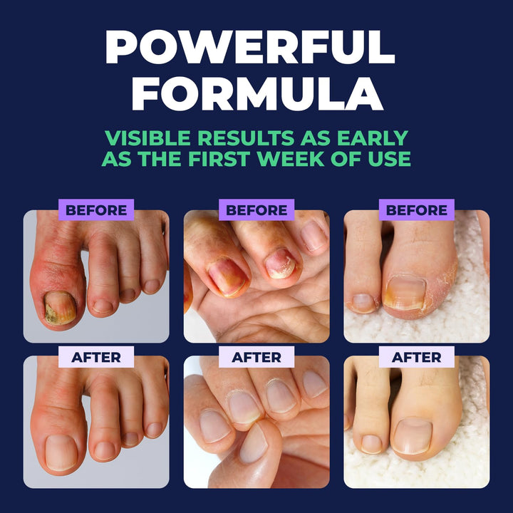 Orivelle - Bolígrafo para el cuidado de uñas, cuidado cosmético par...