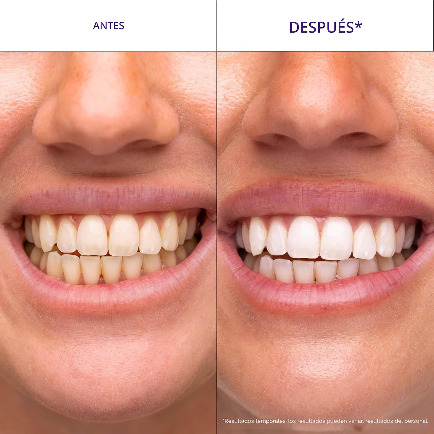 Hismile V34 Tiras blanqueadoras, tiras blanqueadoras de dientes, ti...