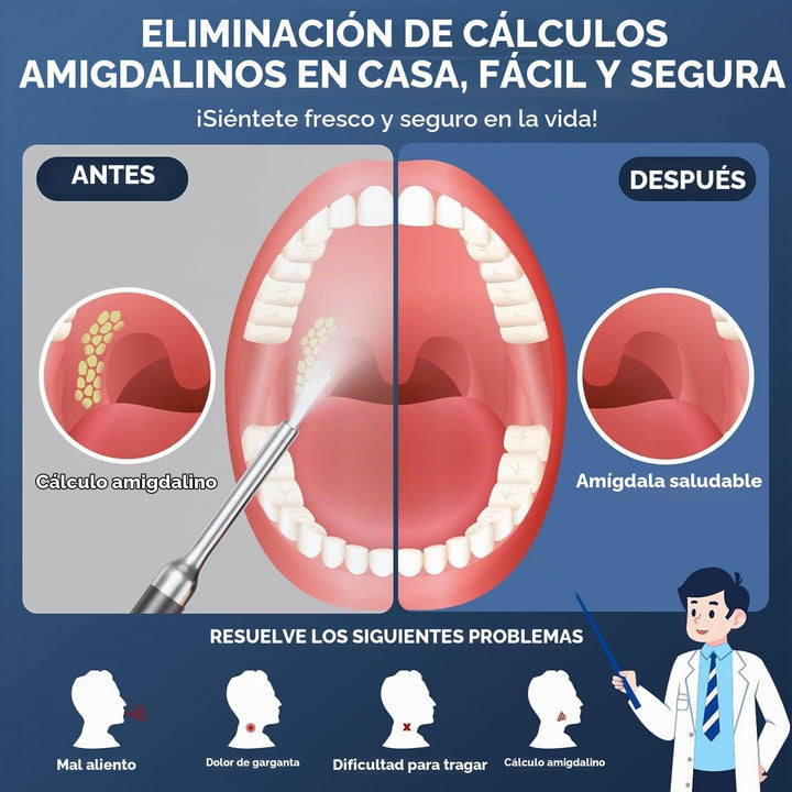 Removedor de piedras amígdalas con cámara \u2013 Kit de eliminación...