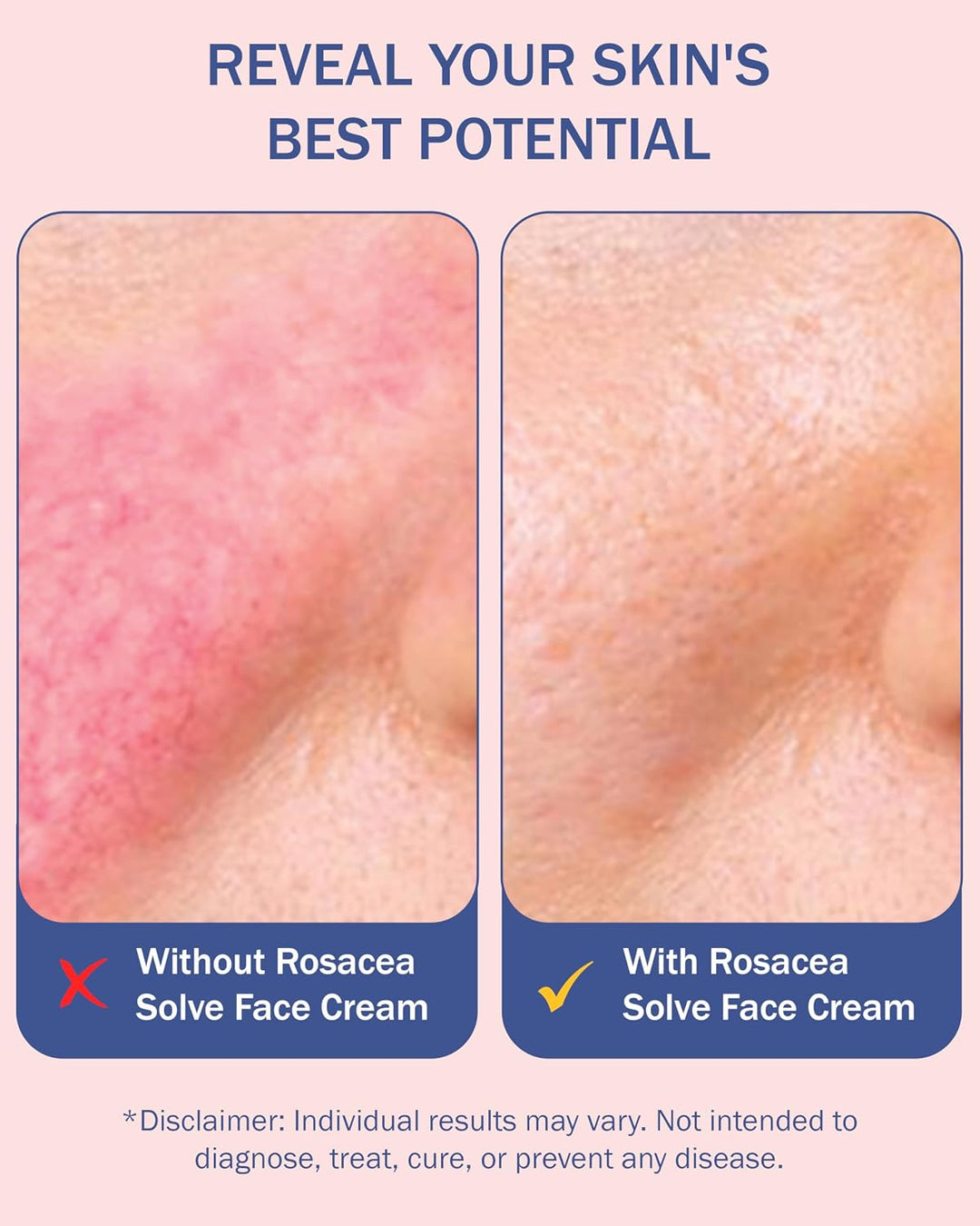 Tratamiento para rosácea para el cuidado de la piel facial en crema...