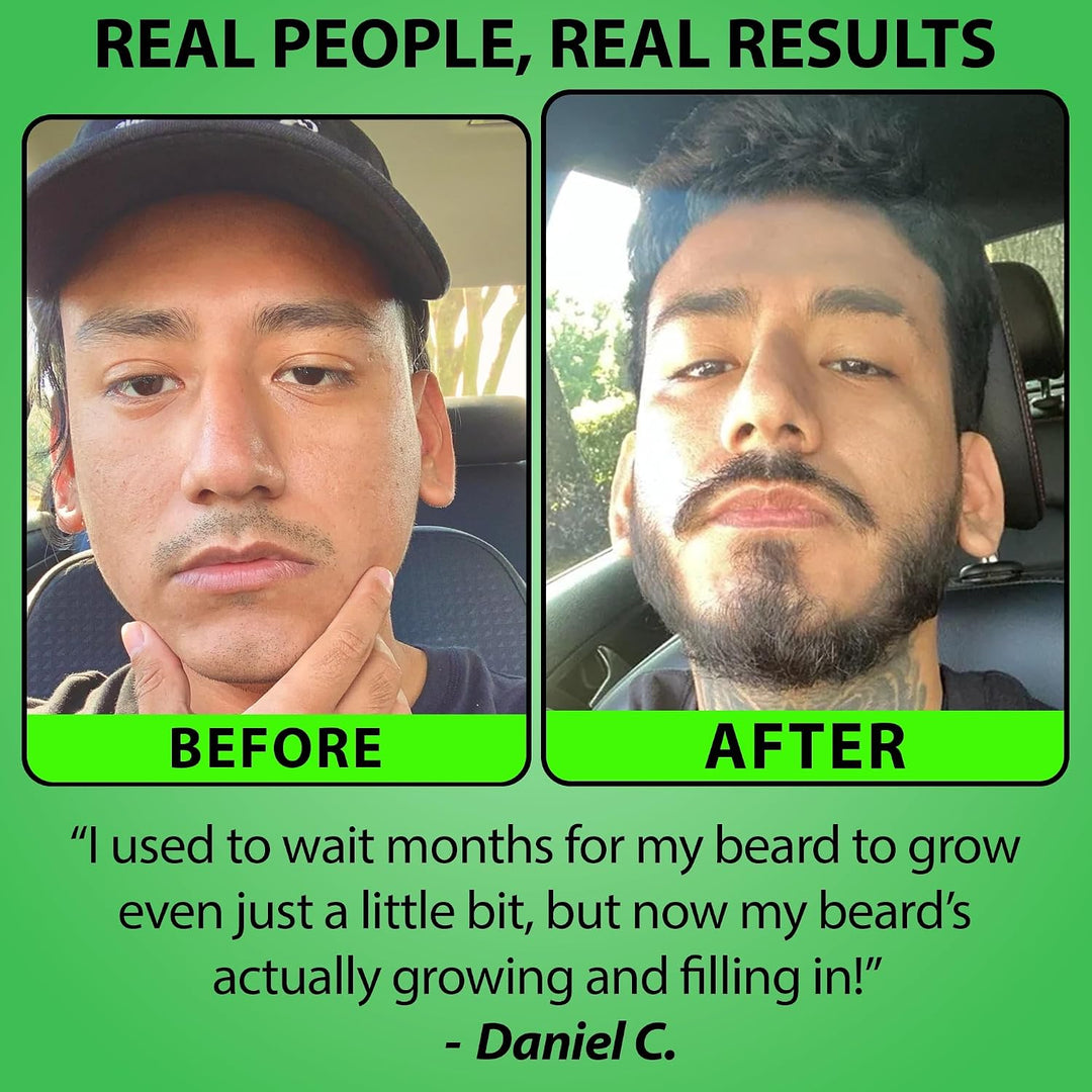 Minoxidil para el crecimiento de la barba: suero al 5% con 2 veces...