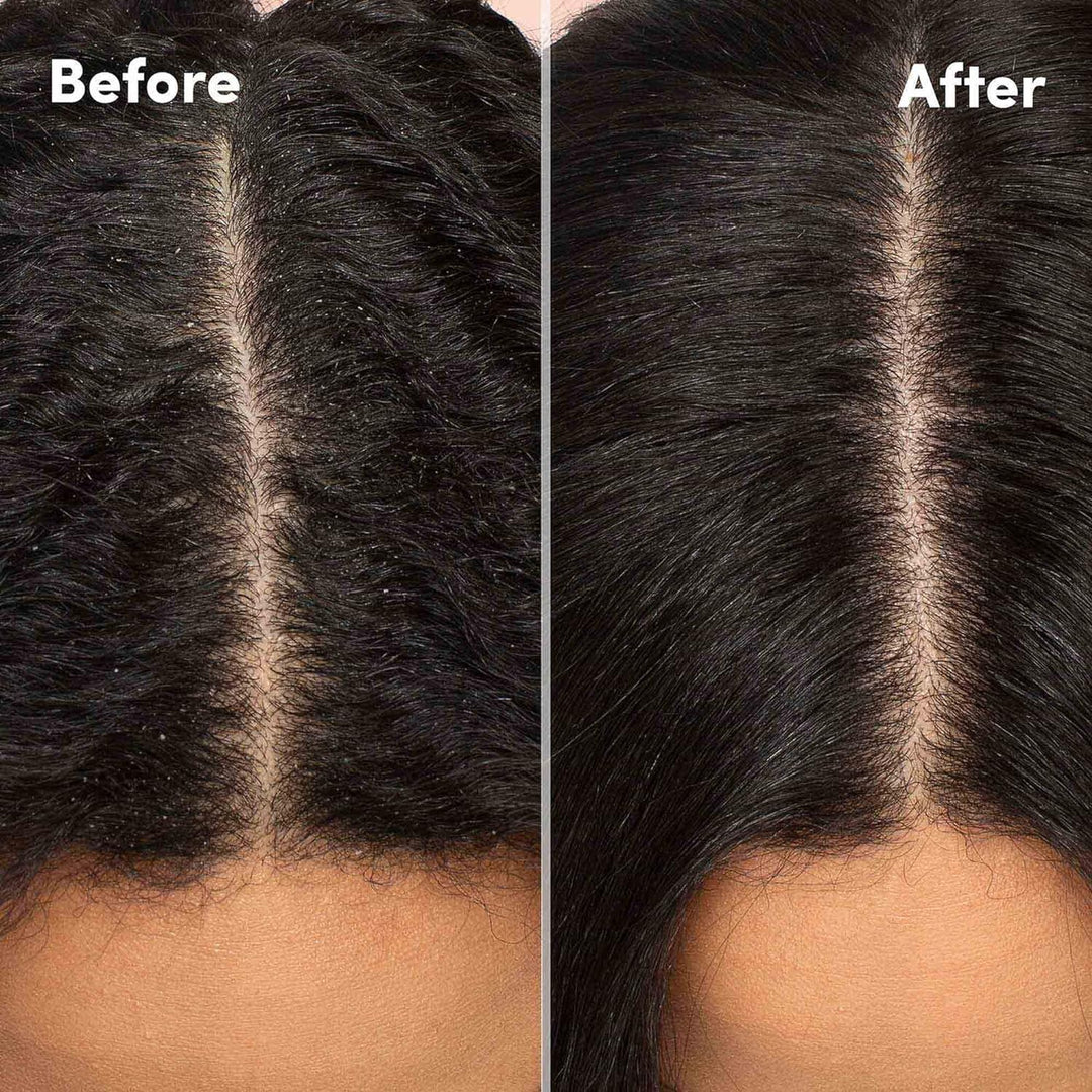 Mizani Scalp Care Loción calmante para el cuero cabelludo | Tratami...
