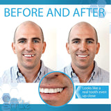 Instant Smile Complete su kit de reemplazo temporal de dientes de s...