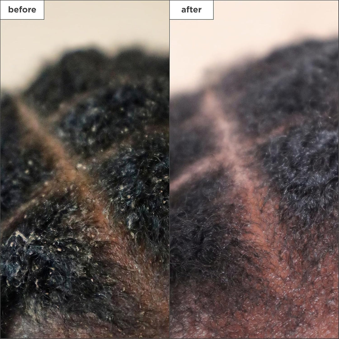Briogeo Scalp Revival - Tratamiento para el cuero cabelludo con car...