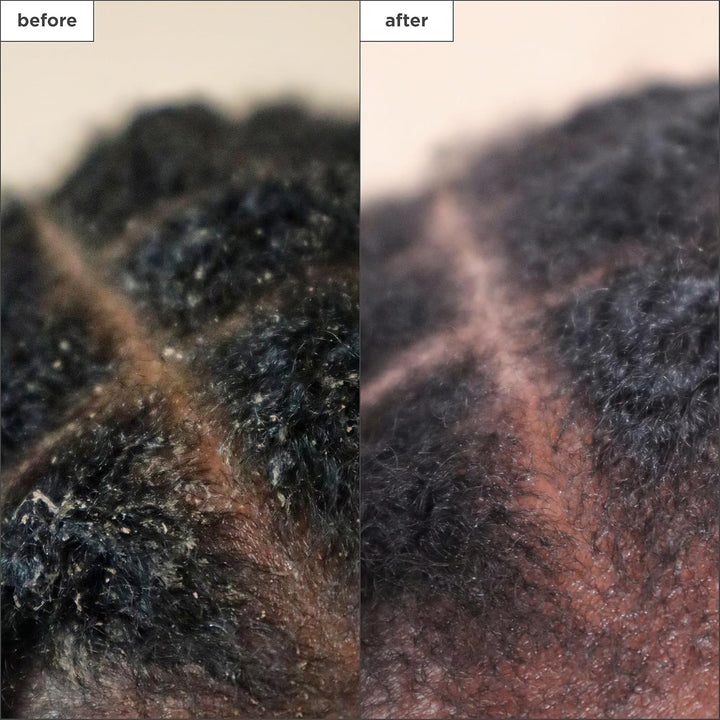 Briogeo Scalp Revival - Tratamiento para el cuero cabelludo con car...