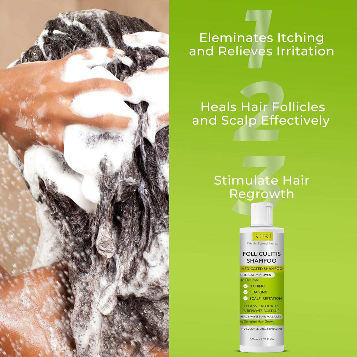 Champú antifúngico para foliculitis, dermatitis seborreica, caspa,...