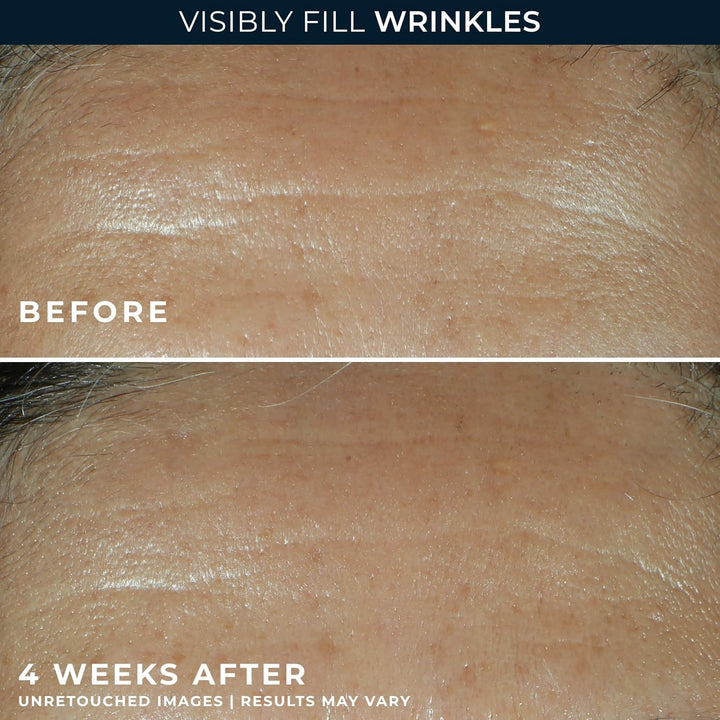 RoC Retinol Correxion - Relleno facial de arrugas profundas con áci...