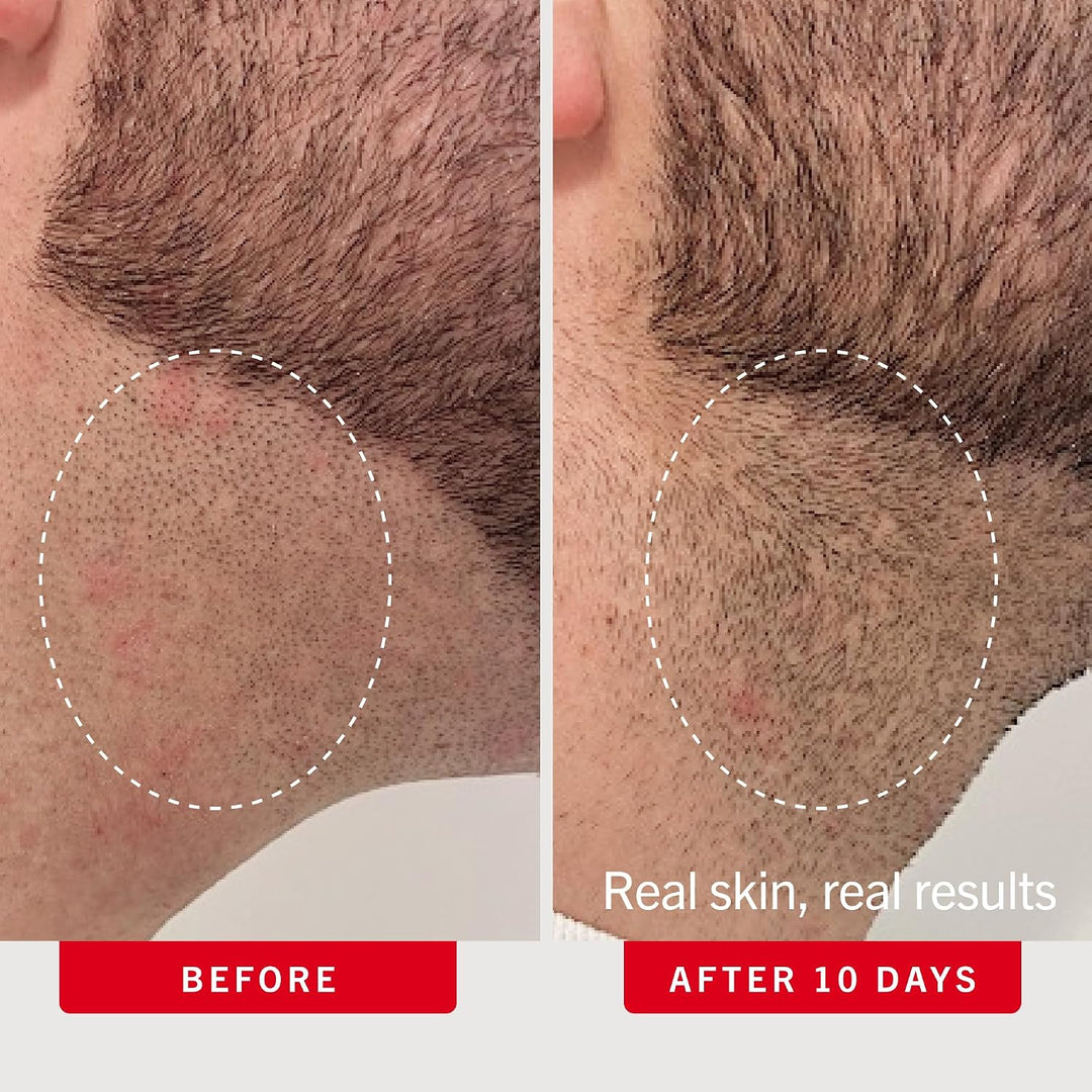 Almohadillas para el cabello encarnadas de First Aid Beauty, tratam...