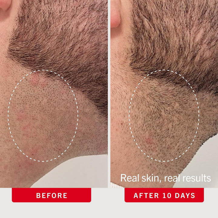 Almohadillas para el cabello encarnadas de First Aid Beauty, tratam...