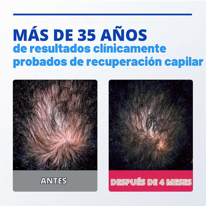 Solución Rogaine para hombres, suministro de un mes | Hair Loss &am...