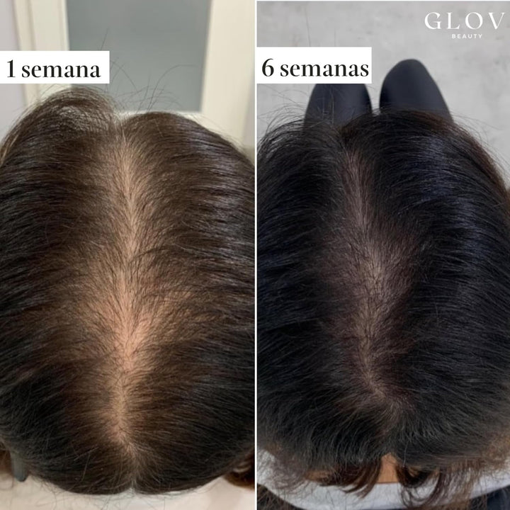 Kit de Renovación Capilar Micro Infusión de Glov Beauty \u2013 Esta...