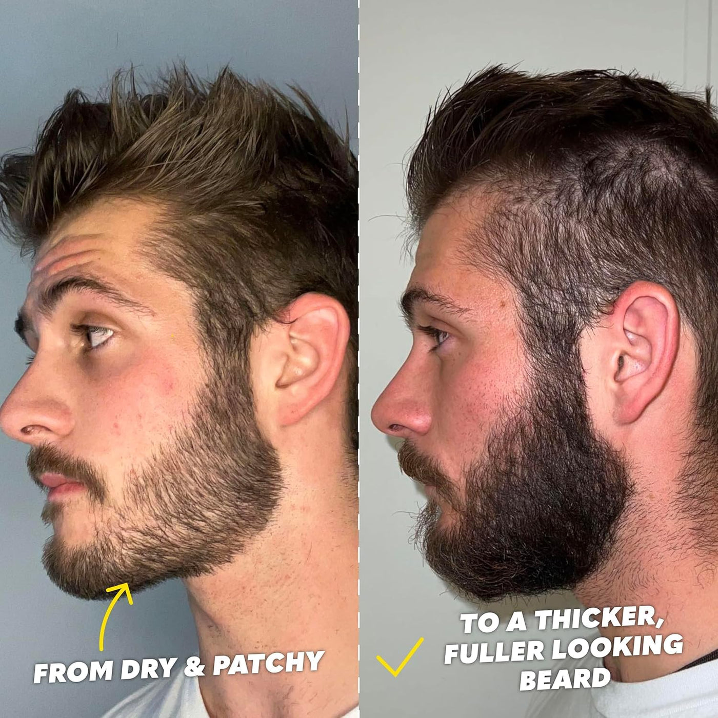 The Beard Club Supreme Kit de Crecimiento de Barba - Rodillo Derma,...