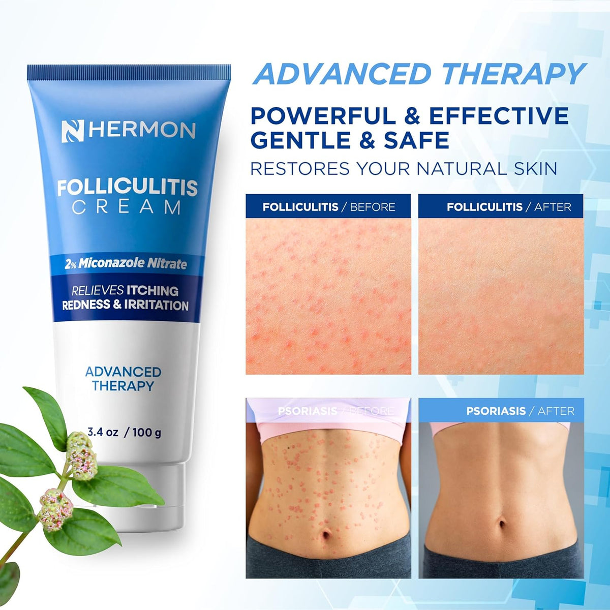 Hermon Crema de foliculitis: eficaz para la foliculitis cuero cabel...