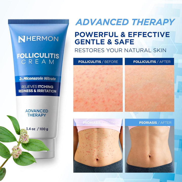 Hermon Crema de foliculitis: eficaz para la foliculitis cuero cabel...