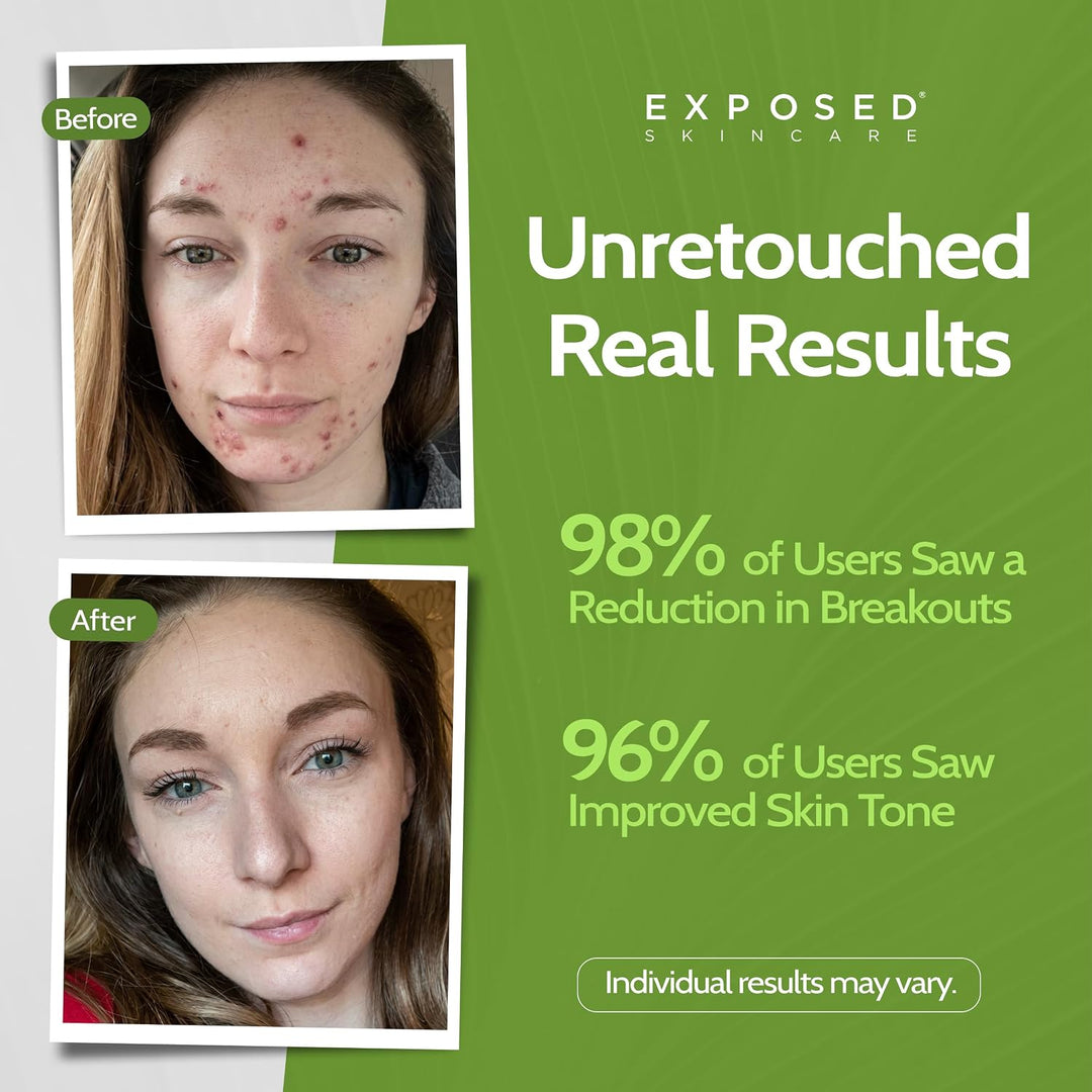 Exposed Skin Care, Microderm - Exfoliante facial con cristales de c...