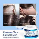 Roycederm Crema para Dermatitis Seborreica, Tratamiento para el Cue...