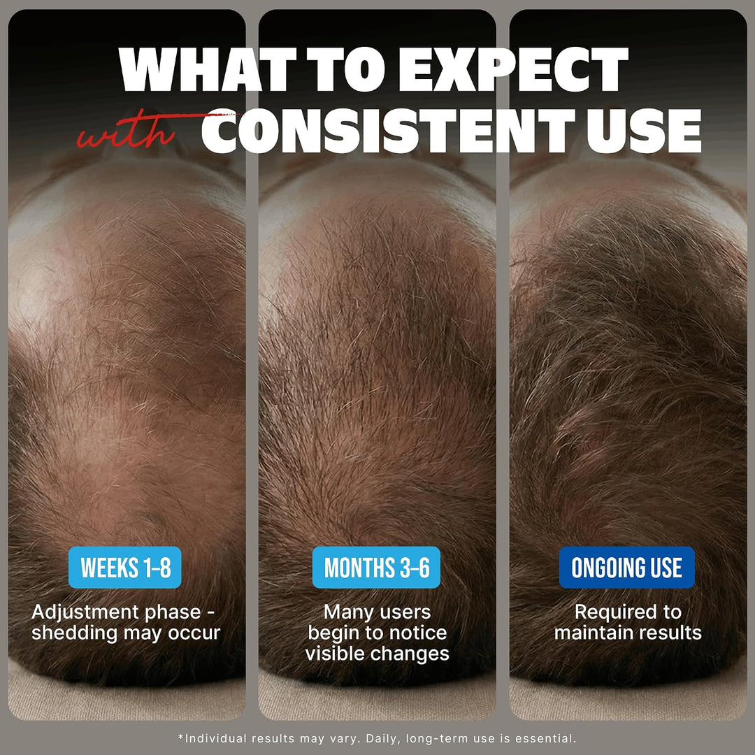 Minoxidil - Tratamiento líquido extra fuerte para el crecimiento de...