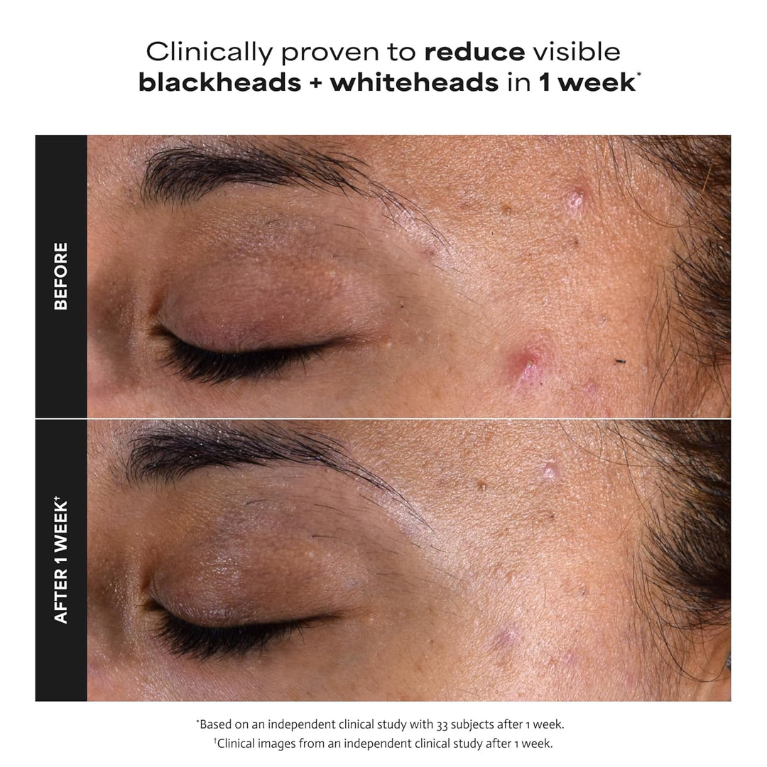 Paula's Choice Skin Perfecting - Exfoliante líquido de ácido sa...