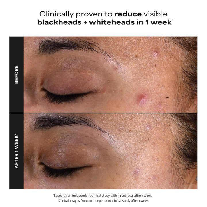 Paula's Choice Skin Perfecting - Exfoliante líquido de ácido sa...