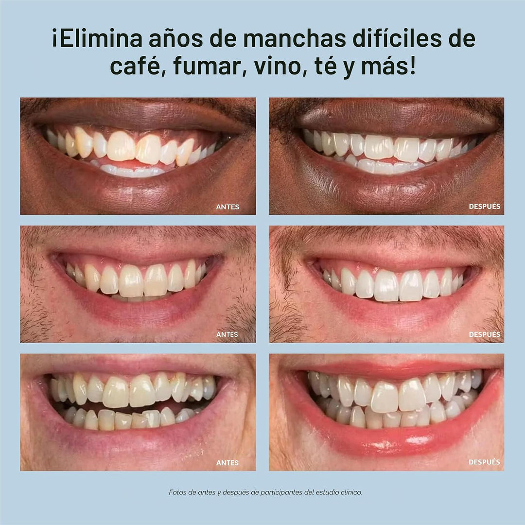 Kit blanqueador de dientes, luz de LED, peróxido de carbamida del 3...