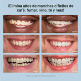 Kit blanqueador de dientes, luz de LED, peróxido de carbamida del 3...