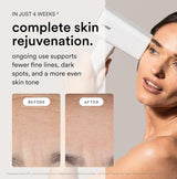 Nood™ NUEVO Flasher Pro \u2014 Dispositivo de depilación láser IPL...