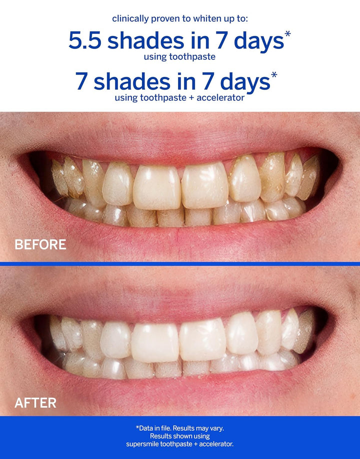 Supersmile Sistema de blanqueamiento, pasta de dientes + acelerador...