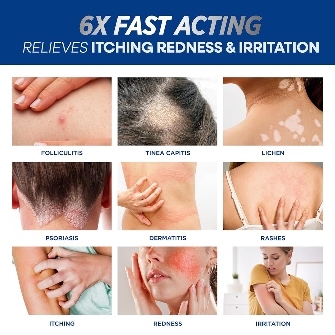 Hermon Crema para foliculitis: eficaz para la foliculitis cuero cab...