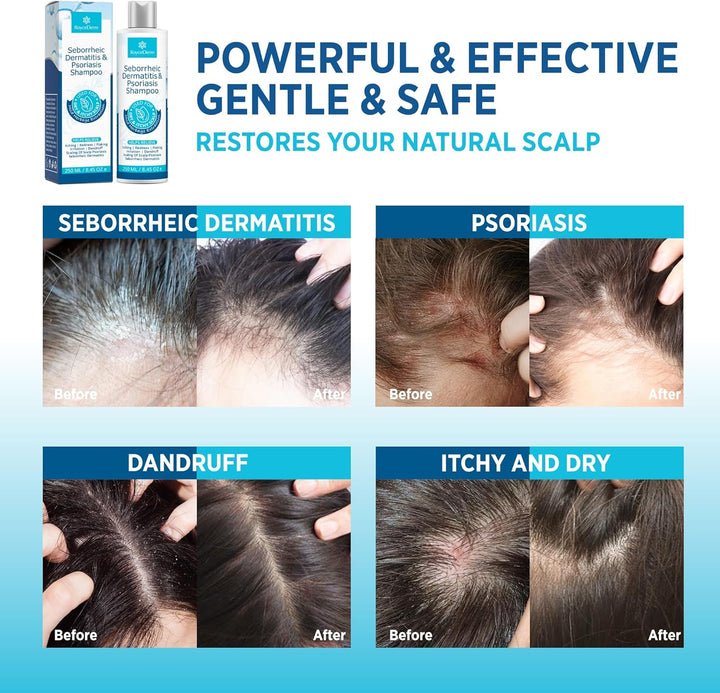 Roycederm Crema facial para dermatitis seborreica y psoriasis, hidr...