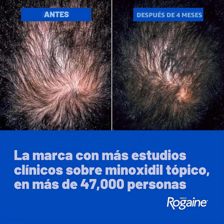 Solución Rogaine para hombres, suministro de un mes