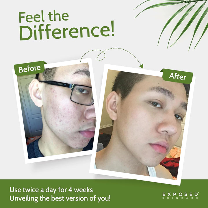Exposed Skin Care, Microderm - Exfoliante facial con cristales de c...
