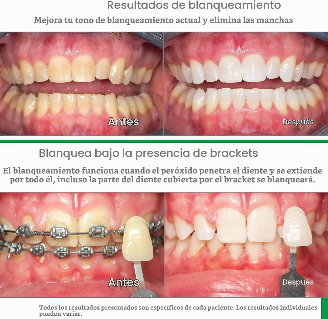 Opalescent Go 10% - Kit de bandejas blanqueadoras dentales precarga...