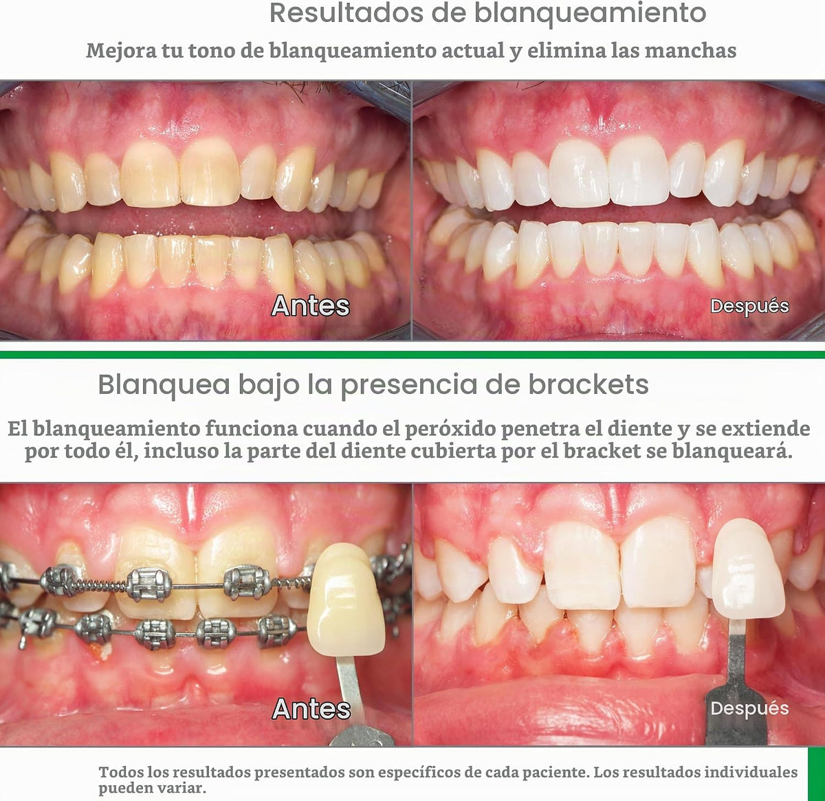 Opalescent Go 10% - Kit de bandejas blanqueadoras dentales precarga...