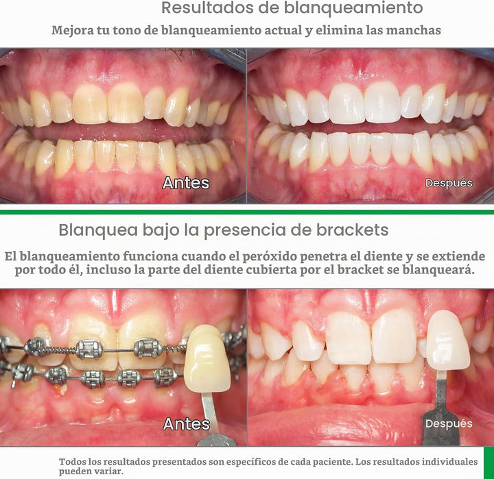 Opalescent Go 10% - Kit de bandejas blanqueadoras dentales precarga...