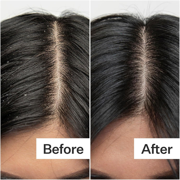 Act+ Acre Exfoliante de ácido salicílico procesado en frío | Para e...