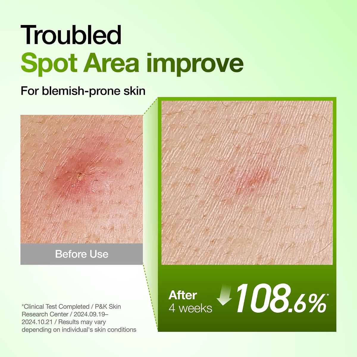 Anua Suero Facial de Ácido Azelaico 10% Hialurónico en Rojo Tranqui...