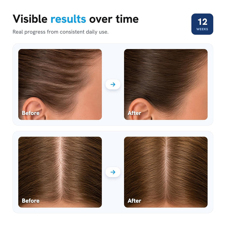 Be Bodywise Advanced Hair Density Roll-On Serum 1.7 fl oz | 5% Saw...