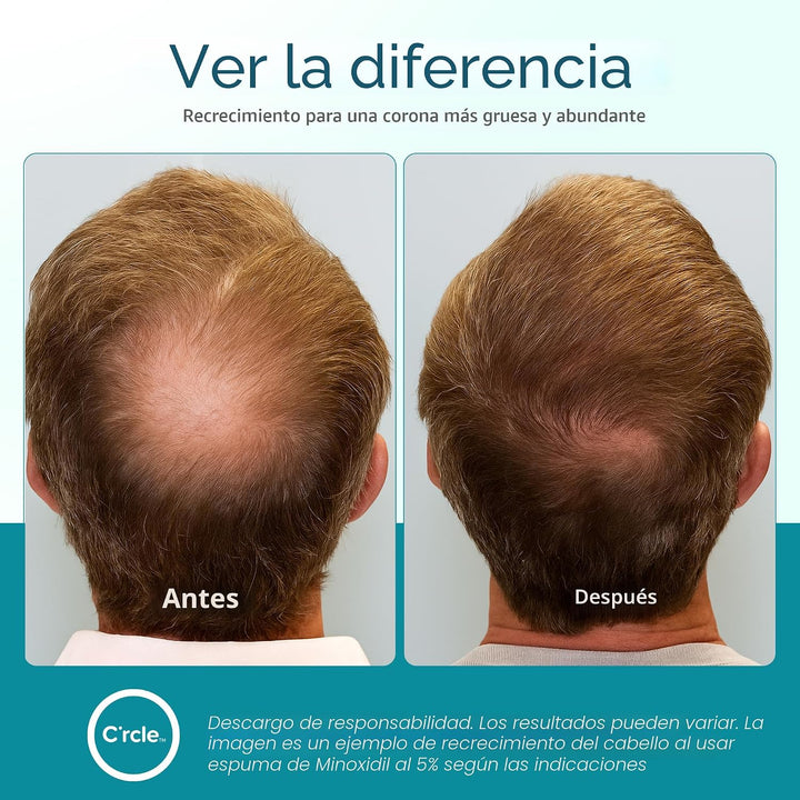 Minoxidil para hombres espuma 5%, suministro sin perfume para 6 mes...