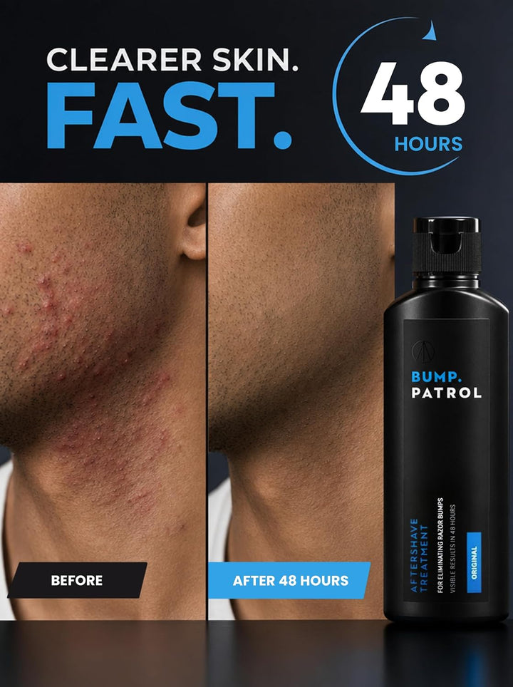 Bump Patrol Original Formula - Sérum para tratamiento de golpes des...