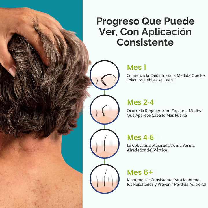 Minoxidil para hombres espuma 5%, suministro sin perfume para 6 mes...