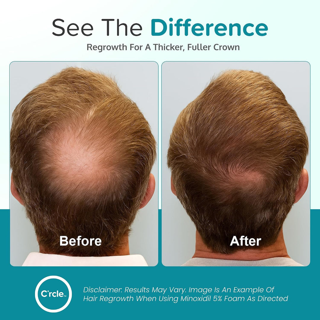 Regoxidine Men's 5% Minoxidil Foam ayuda a restaurar la pérdida...