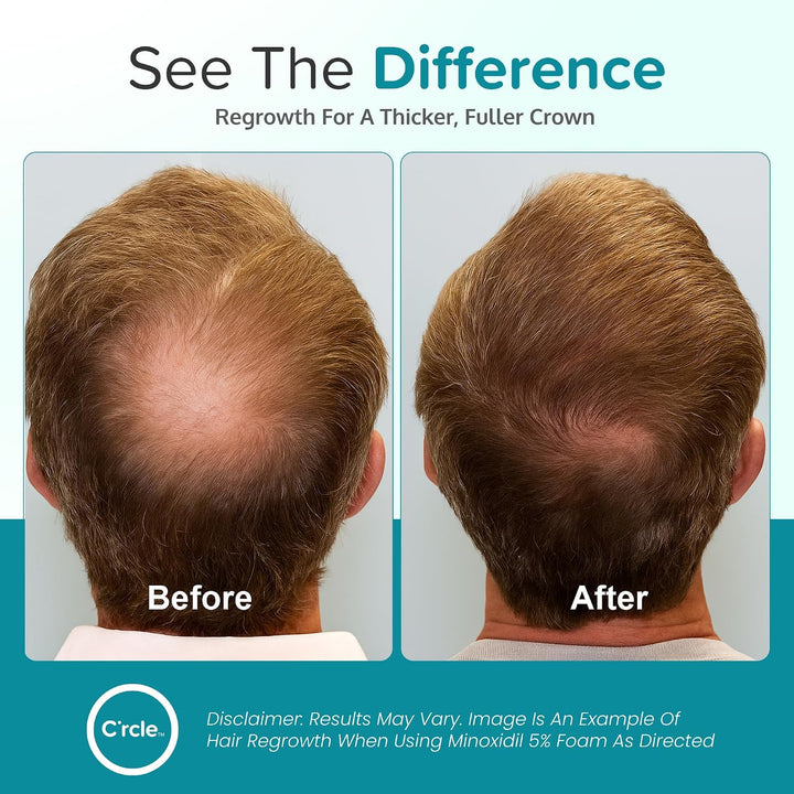 Regoxidine Men's 5% Minoxidil Foam ayuda a restaurar la pérdida...