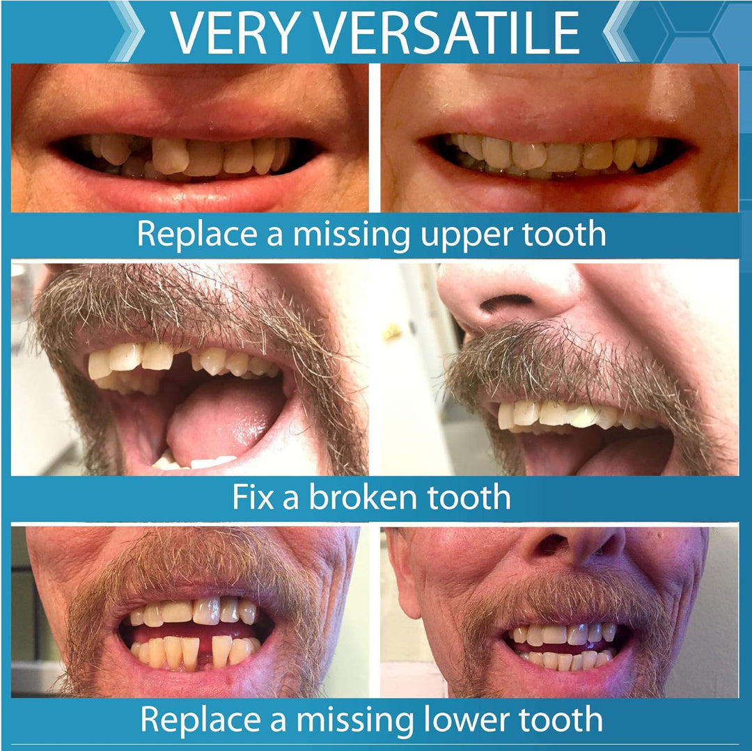 Instant Smile Complete su kit de reemplazo temporal de dientes de s...